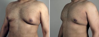 Gynecomastia Reduction Patient 65