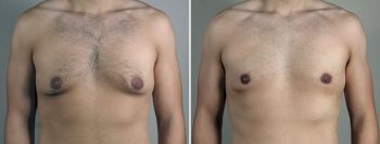 Gynecomastia Reduction Patient 66