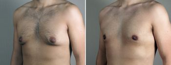 Gynecomastia Reduction Patient 66