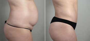 Removal & Replacement of Implants with Tummy Tuck