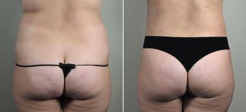Removal & Replacement of Implants with Tummy Tuck