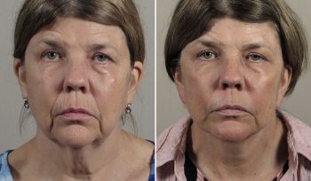 Neck Lift Patient 21