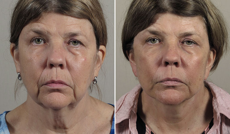 Neck Lift Patient 21