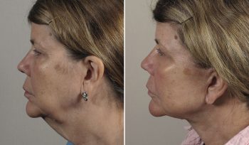 Neck Lift Patient 21
