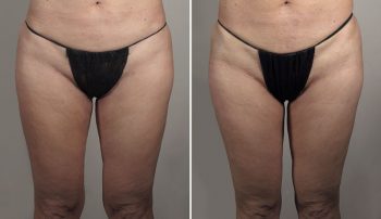 Thigh Lifting Surgery 15