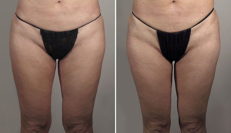 Thigh Lifting Surgery 15