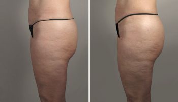 Thigh Lifting Surgery 15