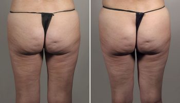 Thigh Lifting Surgery 15