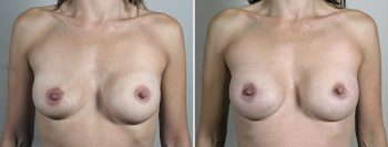 Removal & Replacement of Implants 53