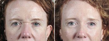 Browlift Patient 24