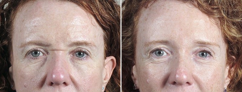 Browlift Patient 24