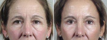 Browlift & Eyelid Lift Patient 25
