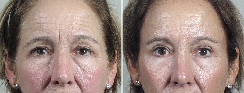 Browlift & Eyelid Lift Patient 25