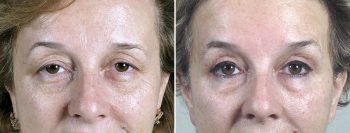 Upper Eyelid Lift Patient 36