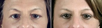 Upper Eyelid Lift Patient 37