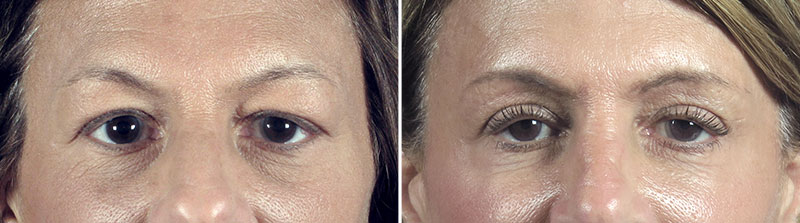 Upper Eyelid Lift Patient 37