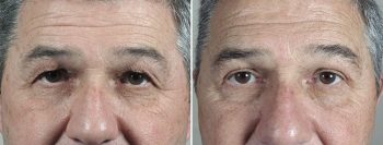 Upper Eyelid Lift & Brow Lift Patient 38