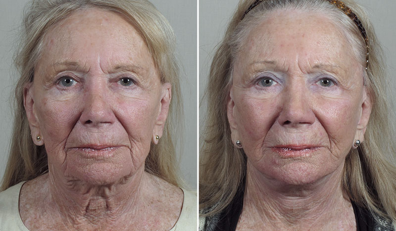 Facelift & Neck lift Patient 36