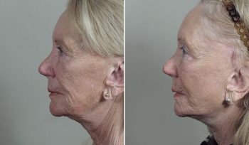 Facelift & Neck lift Patient 36