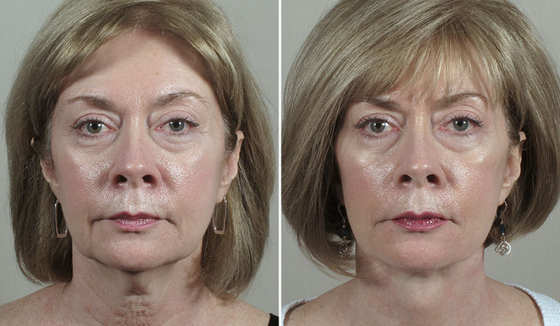 Facelift & Neck lift Patient 35