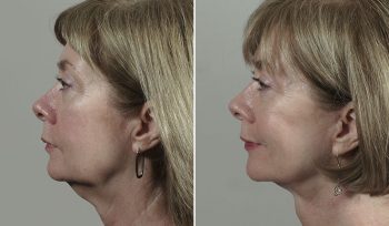 Facelift & Neck lift Patient 35