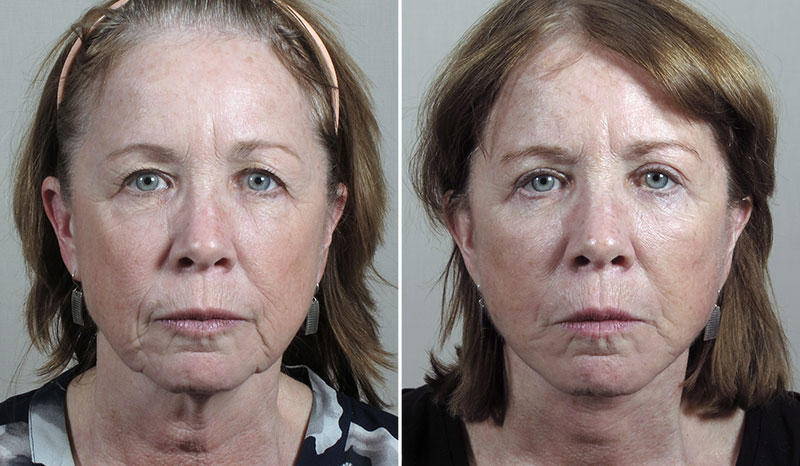 Facelift, Neck lift & Eyelid Lift Patient 34
