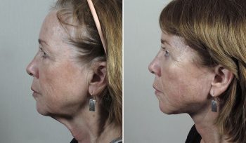 Facelift, Neck lift & Eyelid Lift Patient 34