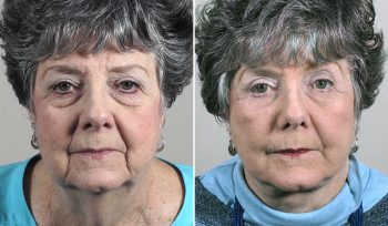 Facelift, Neck lift & Eyelid Lift Patient 35
