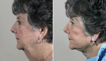 Facelift, Neck lift & Eyelid Lift Patient 35