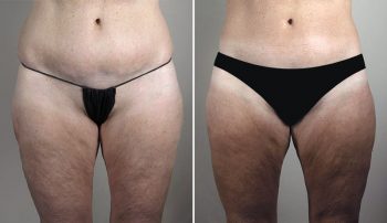 Thigh & Buttock Lifting Surgery 17
