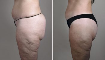 Thigh & Buttock Lifting Surgery 17