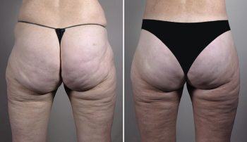 Thigh & Buttock Lifting Surgery 17