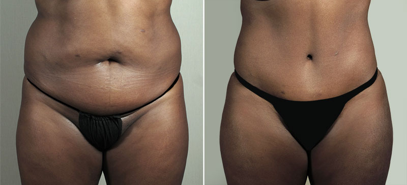 Parker Tummy Tuck Patient 64