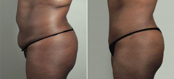 Parker Tummy Tuck Patient 64