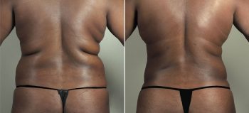 Parker Tummy Tuck Patient 64