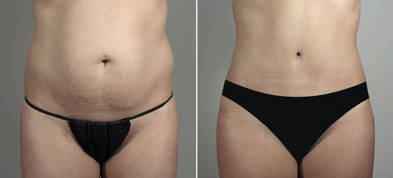 Parker Tummy Tuck Patient 65
