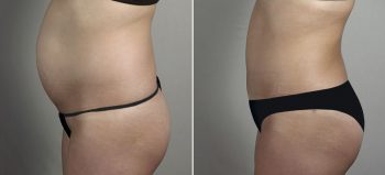 Parker Tummy Tuck Patient 65