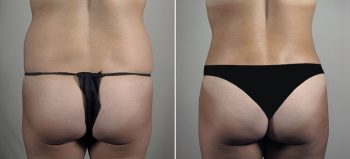 Parker Tummy Tuck Patient 65