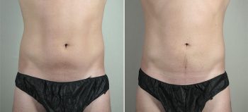 Liposuction of the Abdomen & Flanks Patient 70