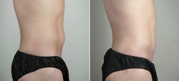 Liposuction of the Abdomen & Flanks Patient 70