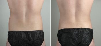 Liposuction of the Abdomen & Flanks Patient 70