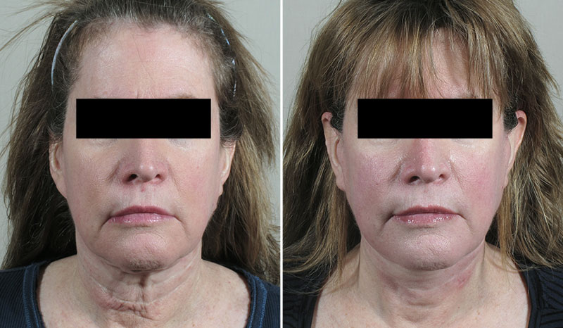 Neck Lift Patient 47