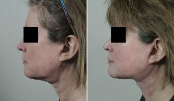 Neck Lift Patient 47