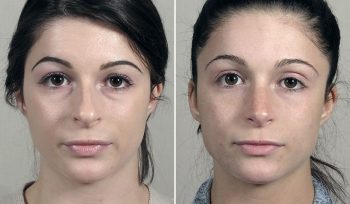 Rhinoplasty Patient 72
