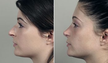 Rhinoplasty Patient 72