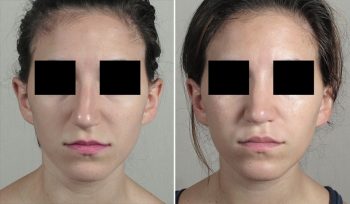 Rhinoplasty Patient 74
