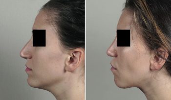 Rhinoplasty Patient 74