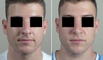 Rhinoplasty Patient 75