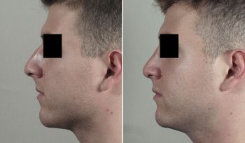 Rhinoplasty Patient 75