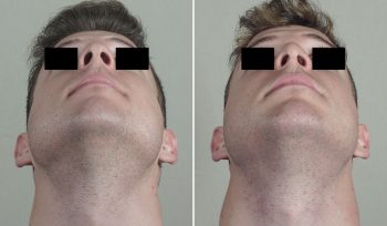 Rhinoplasty Patient 75
